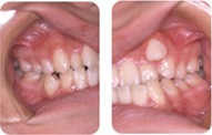 八重歯の矯正症例