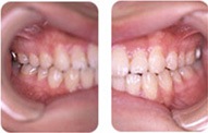 八重歯の矯正症例