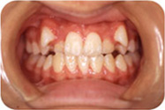 歯数不足の症例
